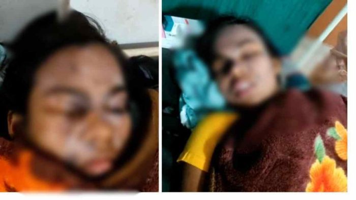 CG NEWS: Two girl students scorched due to falling of acid bottle in school lab, one girl student referred to Bilaspur
