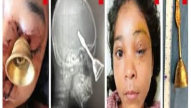 Diwali Accident: A tragic Diwali accident in Bilaspur! A prayer bell entered the eye of a 10-year-old child... A miracle occurred during a successful operation at Raipur DKS.