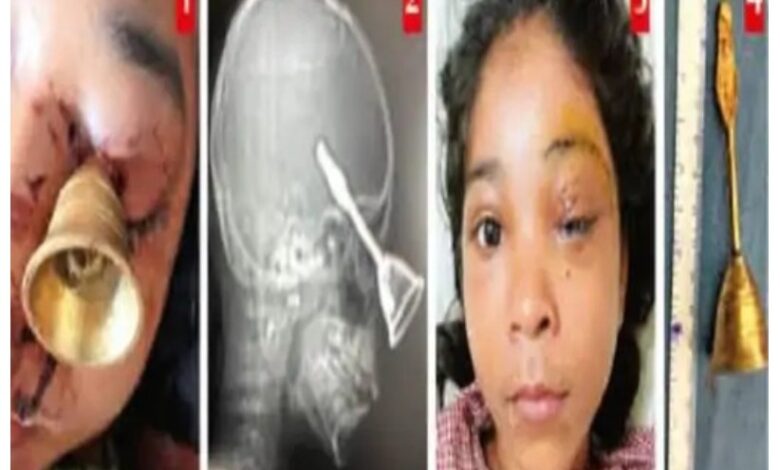 Diwali Accident: A tragic Diwali accident in Bilaspur! A prayer bell entered the eye of a 10-year-old child... A miracle occurred during a successful operation at Raipur DKS.