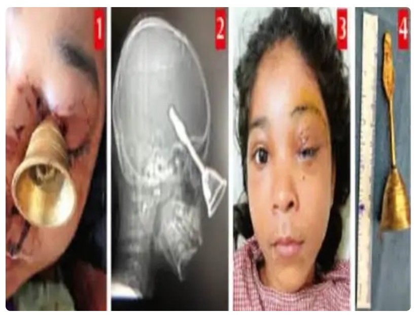 Accident on Diwali : बिलासपुर में दीवाली पर दर्दनाक हादसा…! 10 साल की मासूम की आंख में घुसी पूजा की घंटी…Raipur DKS में सफल ऑपरेशन में हुआ चमत्कार