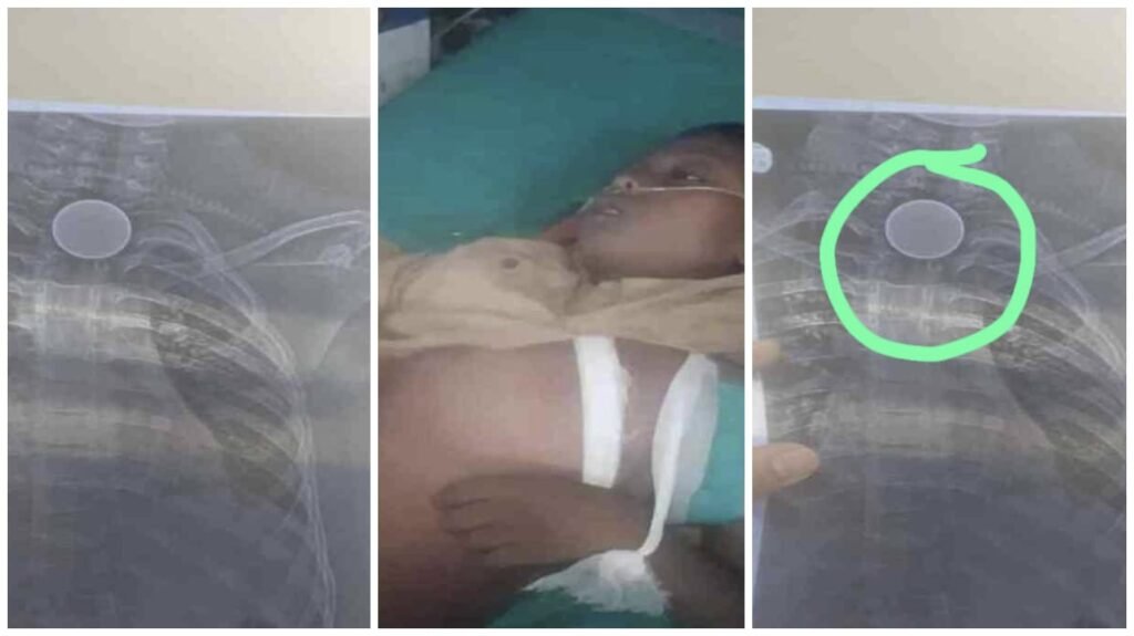 Coins Stuck : कोरबा से हृदयविदारक…! 8 साल के मासूम ने निगला सिक्का…दर्दनाक मौत…परिवार बदहवास