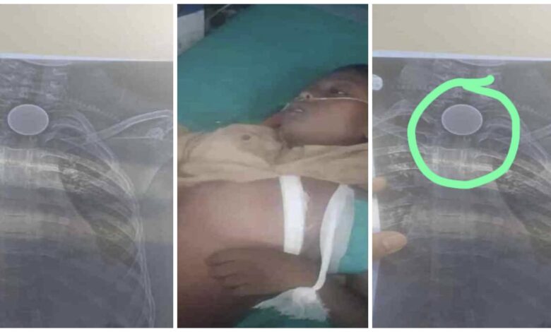 Coin Stuck: Heartbreaking incident from Korba! 8-year-old boy swallows coin... painful death... family distraught.