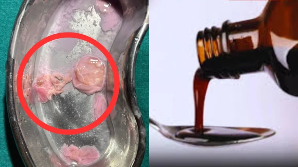 Steak in Syrup : बड़ी खबर…गर्भवती महिला को दी गई कैल्सिड सिरप में निकला मांस जैसा टुकड़ा…! राज्यपाल, CMO और DGP को लिखा पत्र…FDA ने शुरू की तत्काल जांच