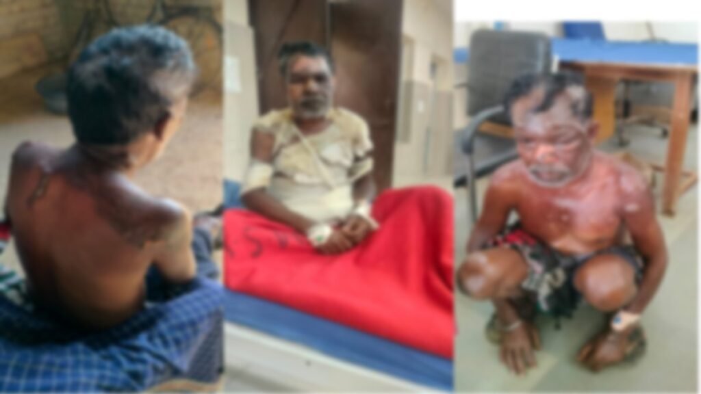 Hot Water Attack : सरगुजा में हैरान कर देने वाली घटना…! शराब बनाने से रोका तो पत्नी ने पति पर उड़ेल दिया उबलता पानी…हालत गंभीर