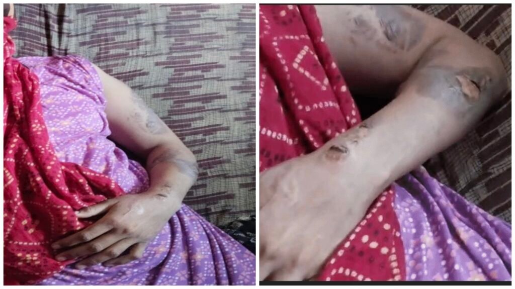 Justice For Women : कानून का रक्षक बना दरिंदा…! SAF जवान अपनी पत्नी को बांधकर गर्म प्रेस से कई बार दागा…7 जगह जले हुए जख्म