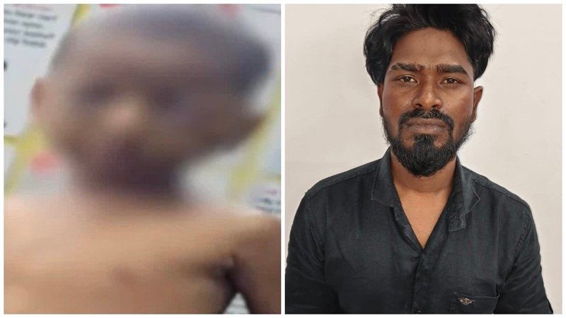 Child Protection: ध्यान से देखें! रायपुर में मासूम को सिगरेट जलाने के आरोपी सौतेले पिता और मां गिरफ्तार; चेहरे और आंख पर अनगिनत चोट के निशान